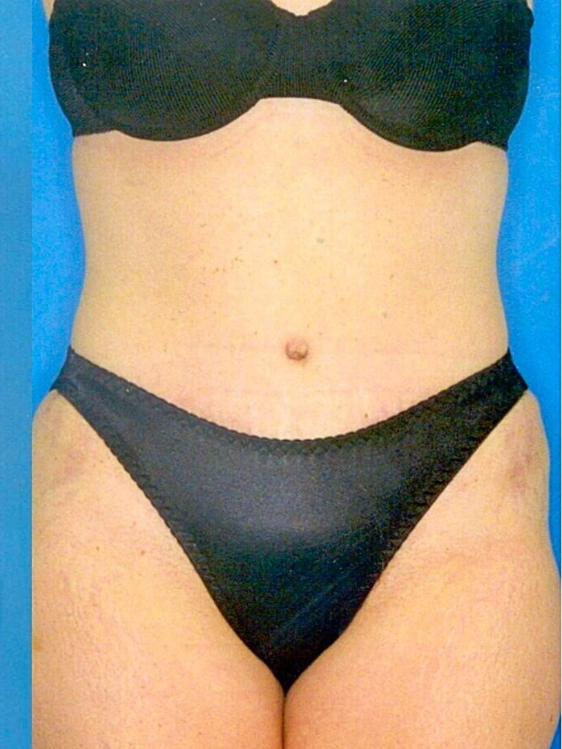 Front View After