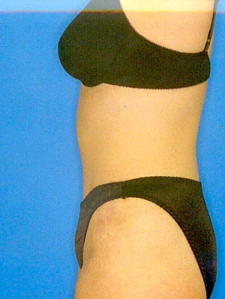 Side View After