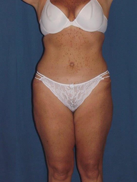Front View After
