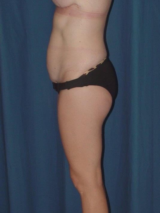 Side View Before