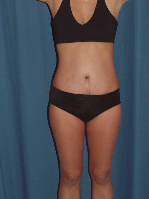 Front View-stretch marks broug After