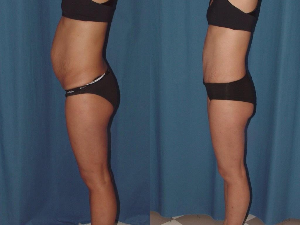 Side View- flatter abdomen Before