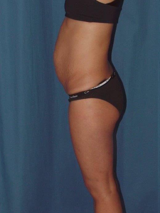 Side View- flatter abdomen Before