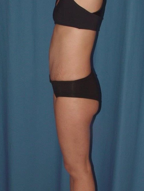 Side View- flatter abdomen After