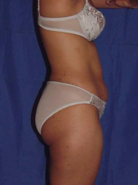 Side View Before