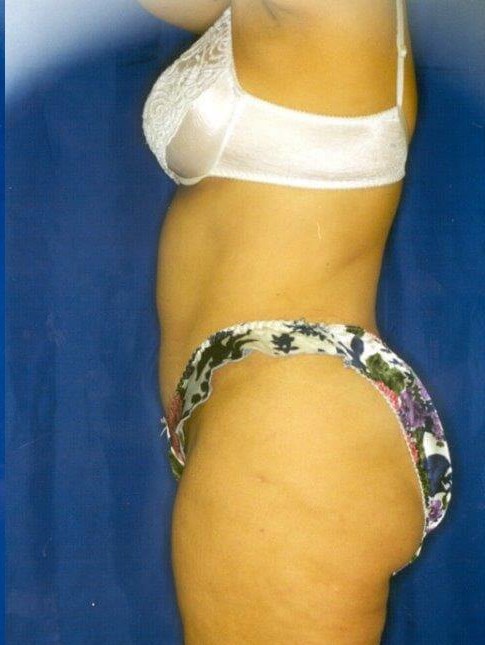 Side View After