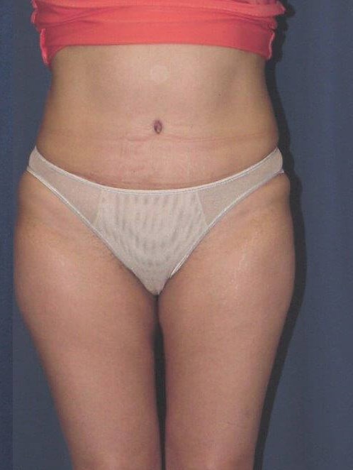 Front View After