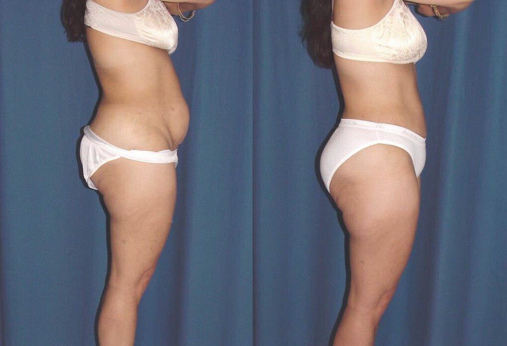 Side View- LOSS OF THE ABDOMIN Before