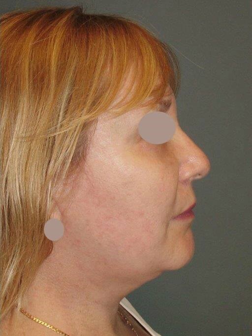 Lateral View After