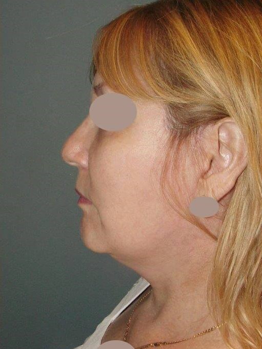 Lateral View After