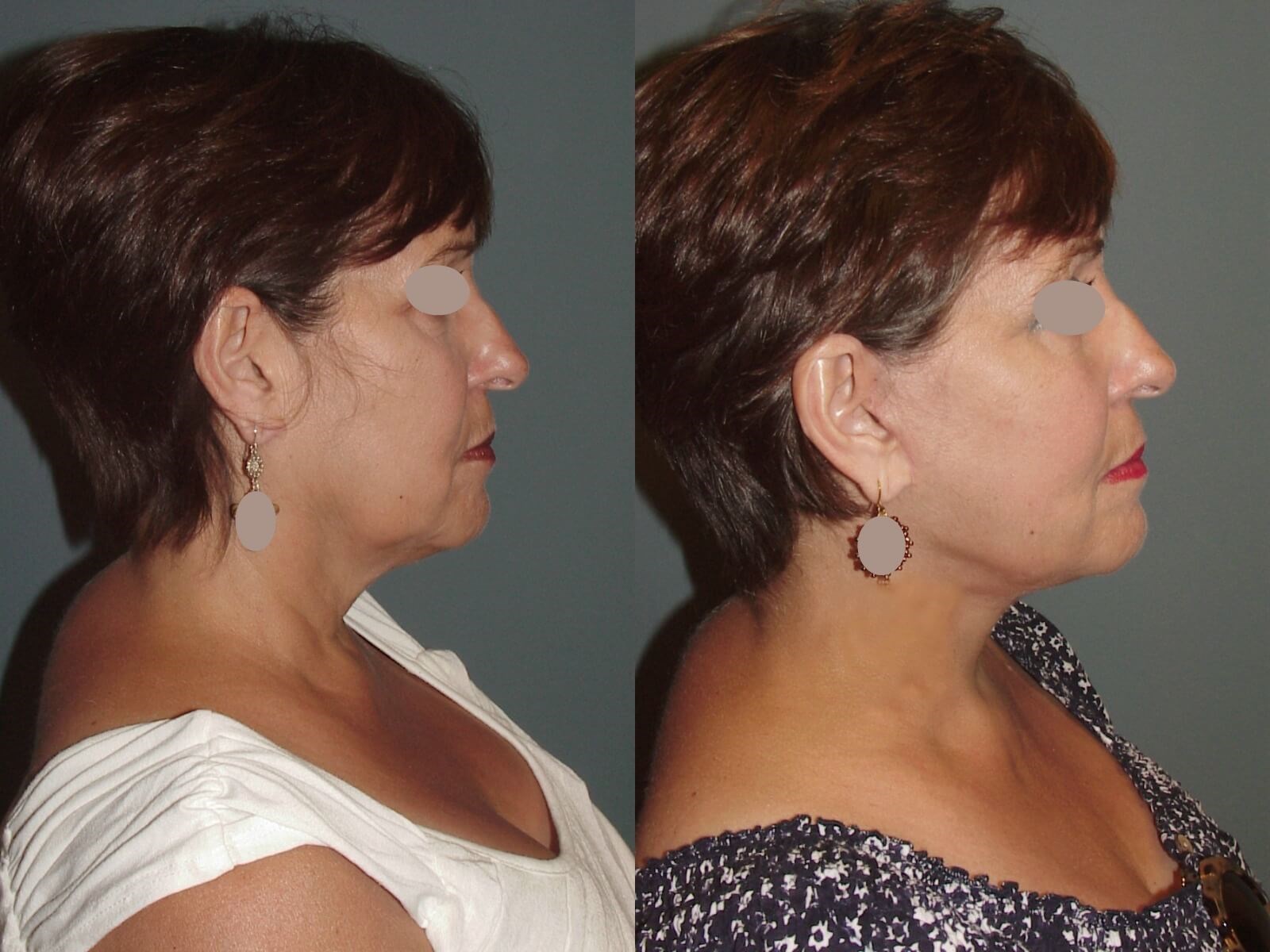 Lateral View Before