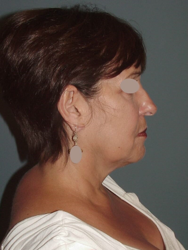 Lateral View Before