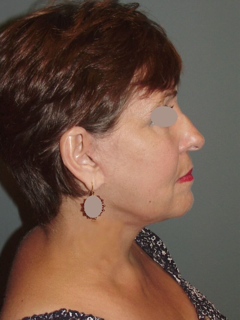 Lateral View After