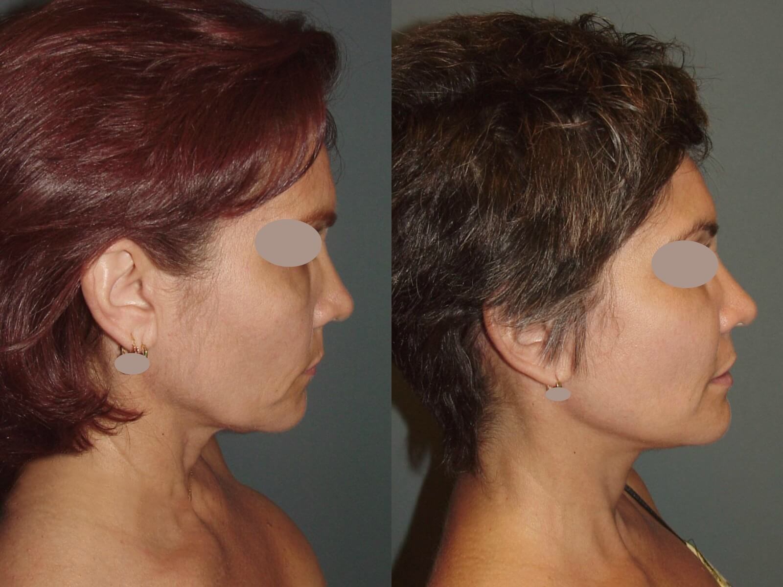 Lateral View Before