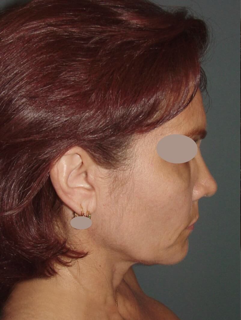 Lateral View Before