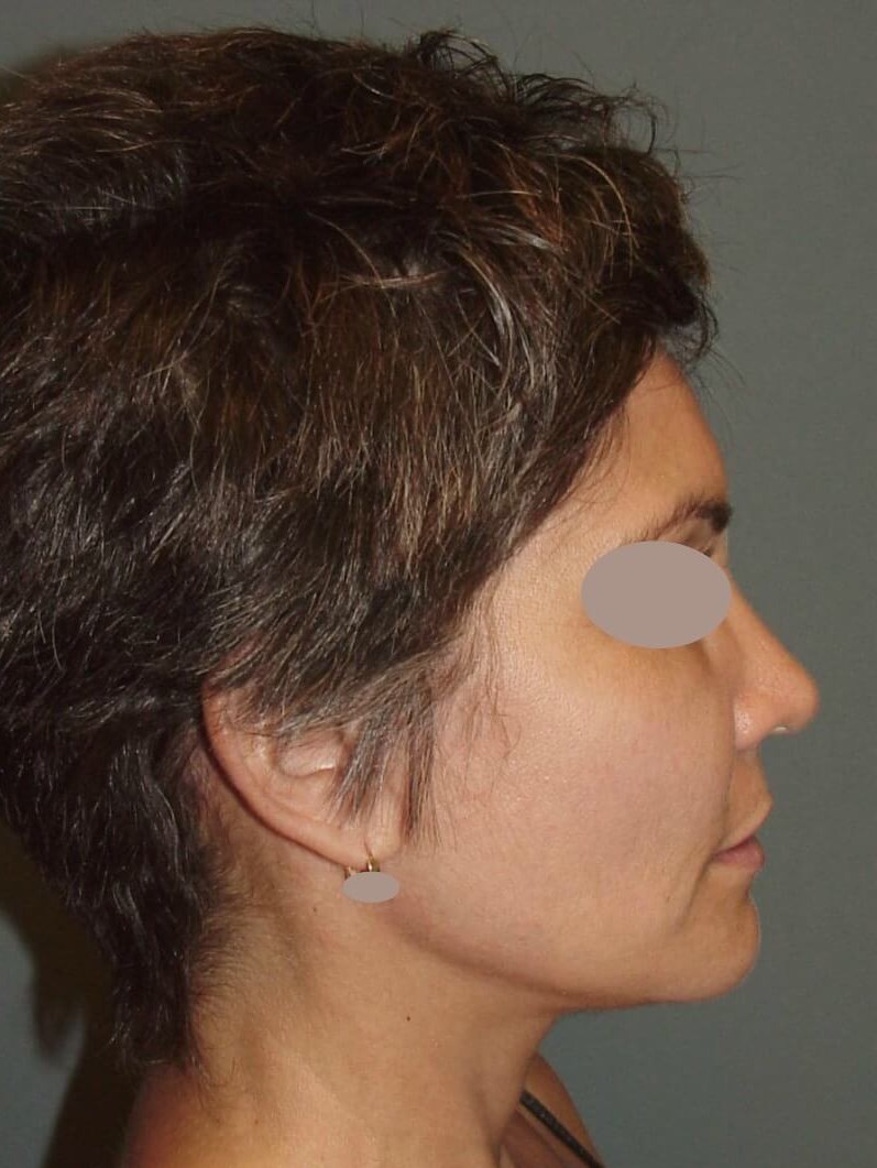 Lateral View After