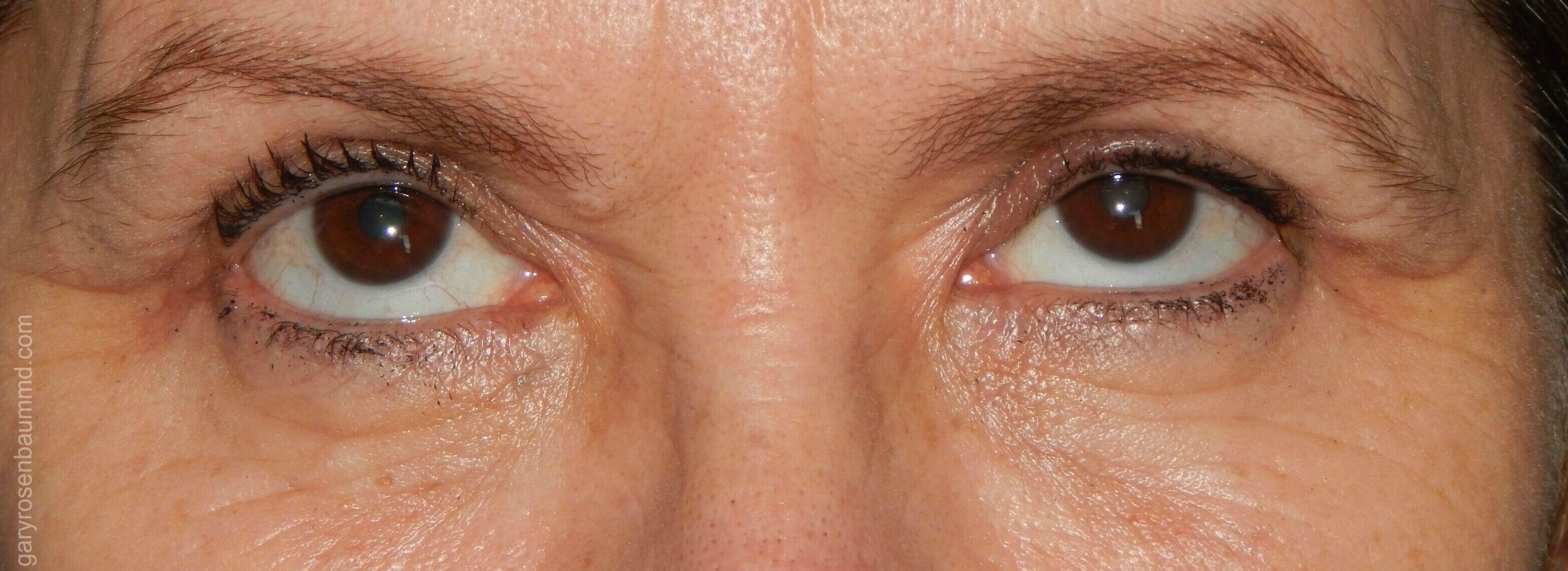 Upper Blepharoplasty After