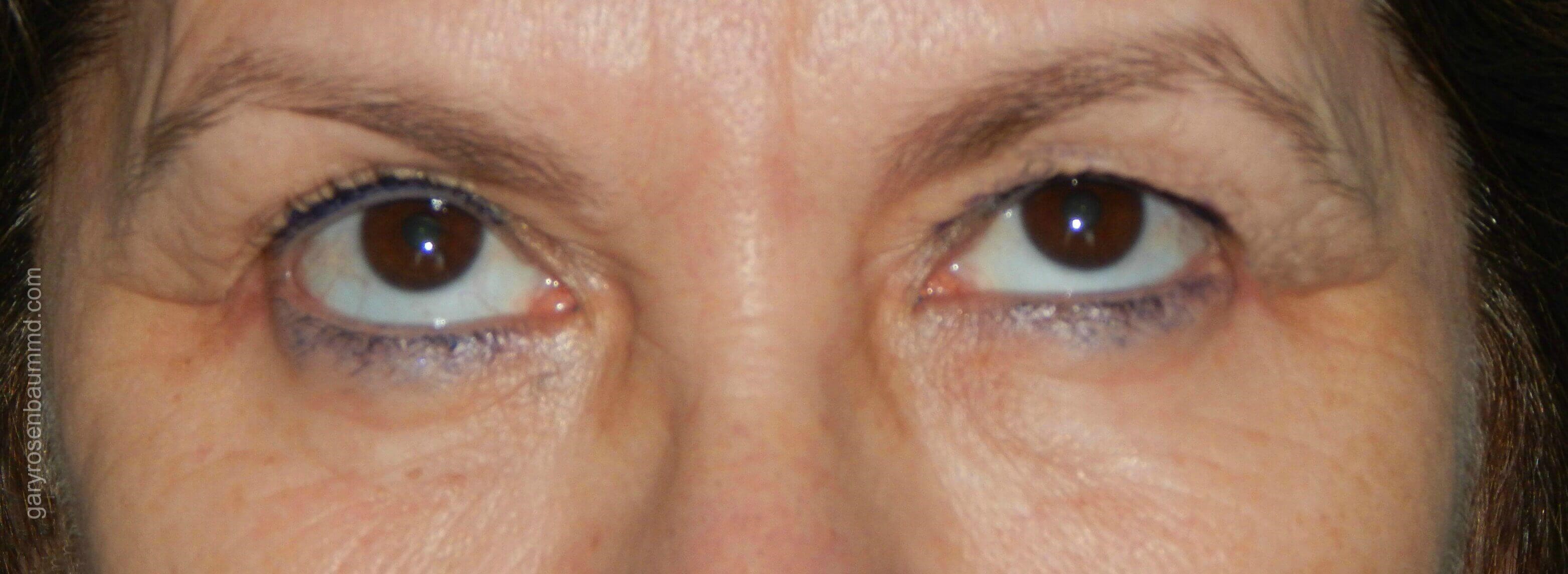 Upper Blepharoplasty Before