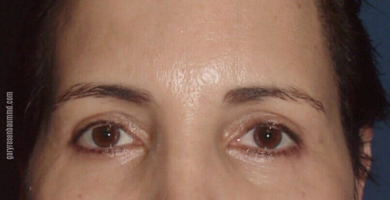 Upper Eyelid Blepharoplasty After