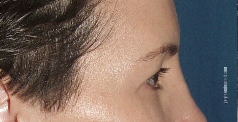 Lateral View Before