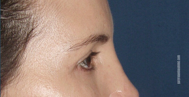 Lateral View After