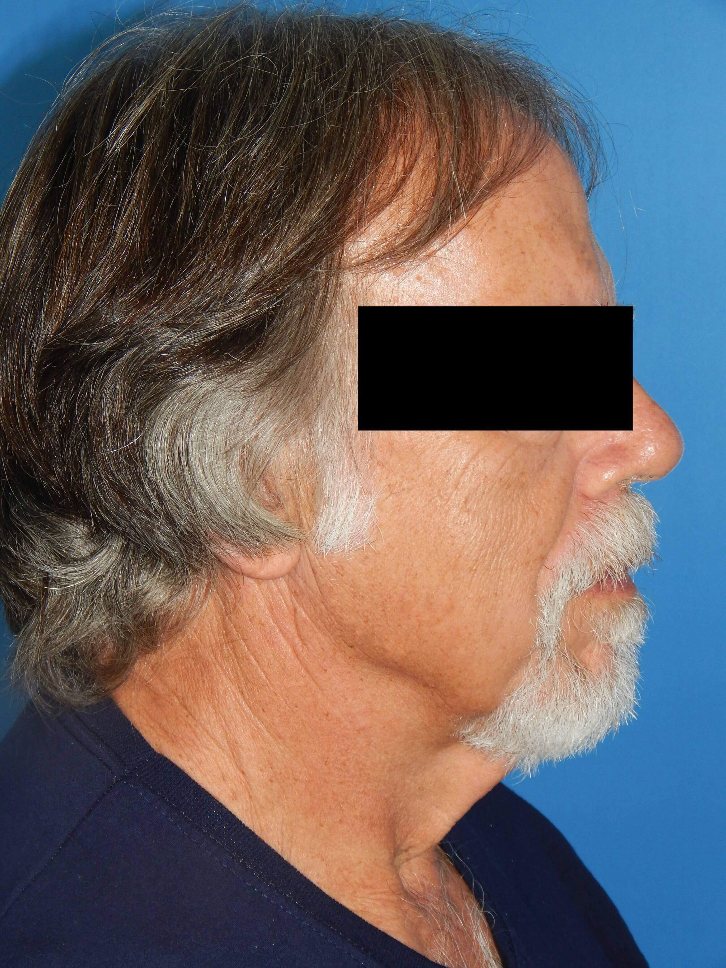 Side View-loose hanging neck s Before
