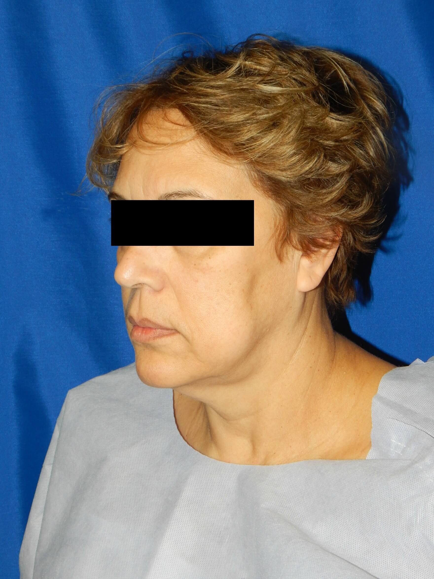 Lateral View Before
