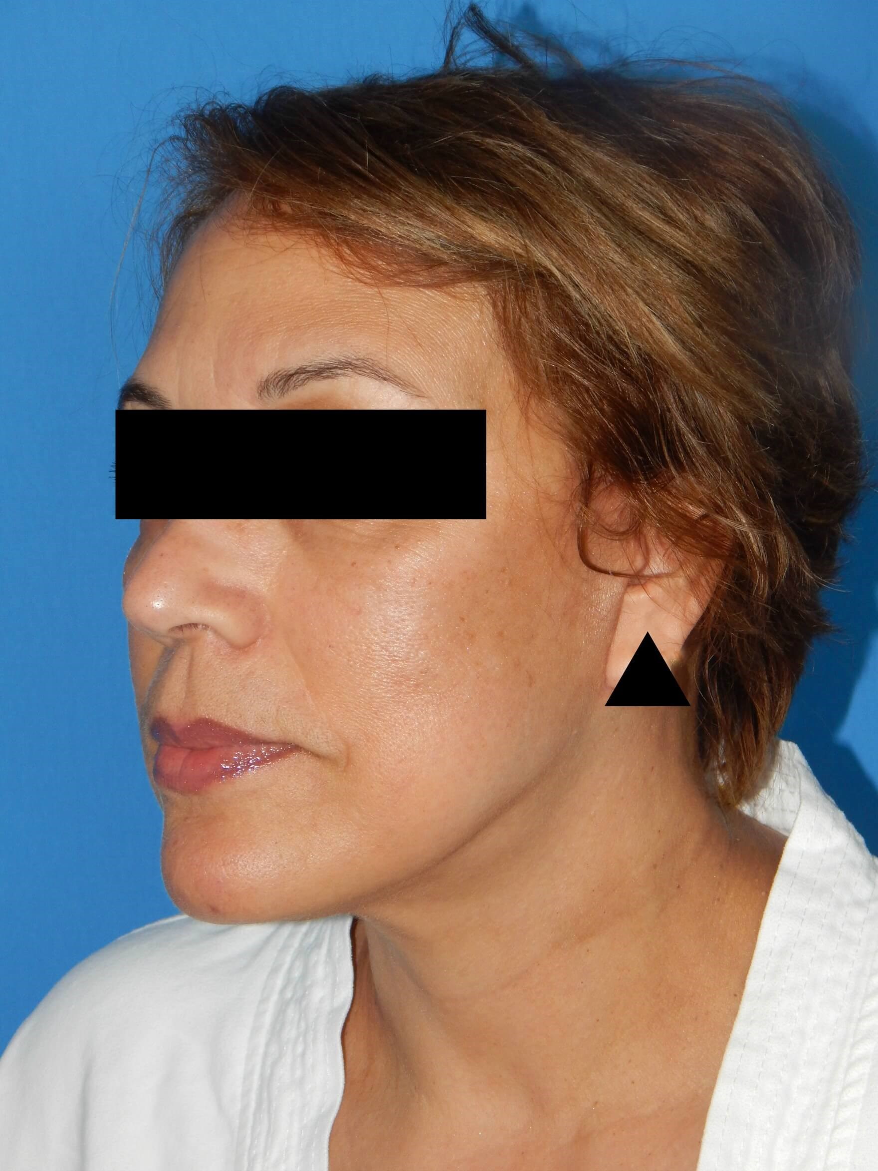 Lateral View After