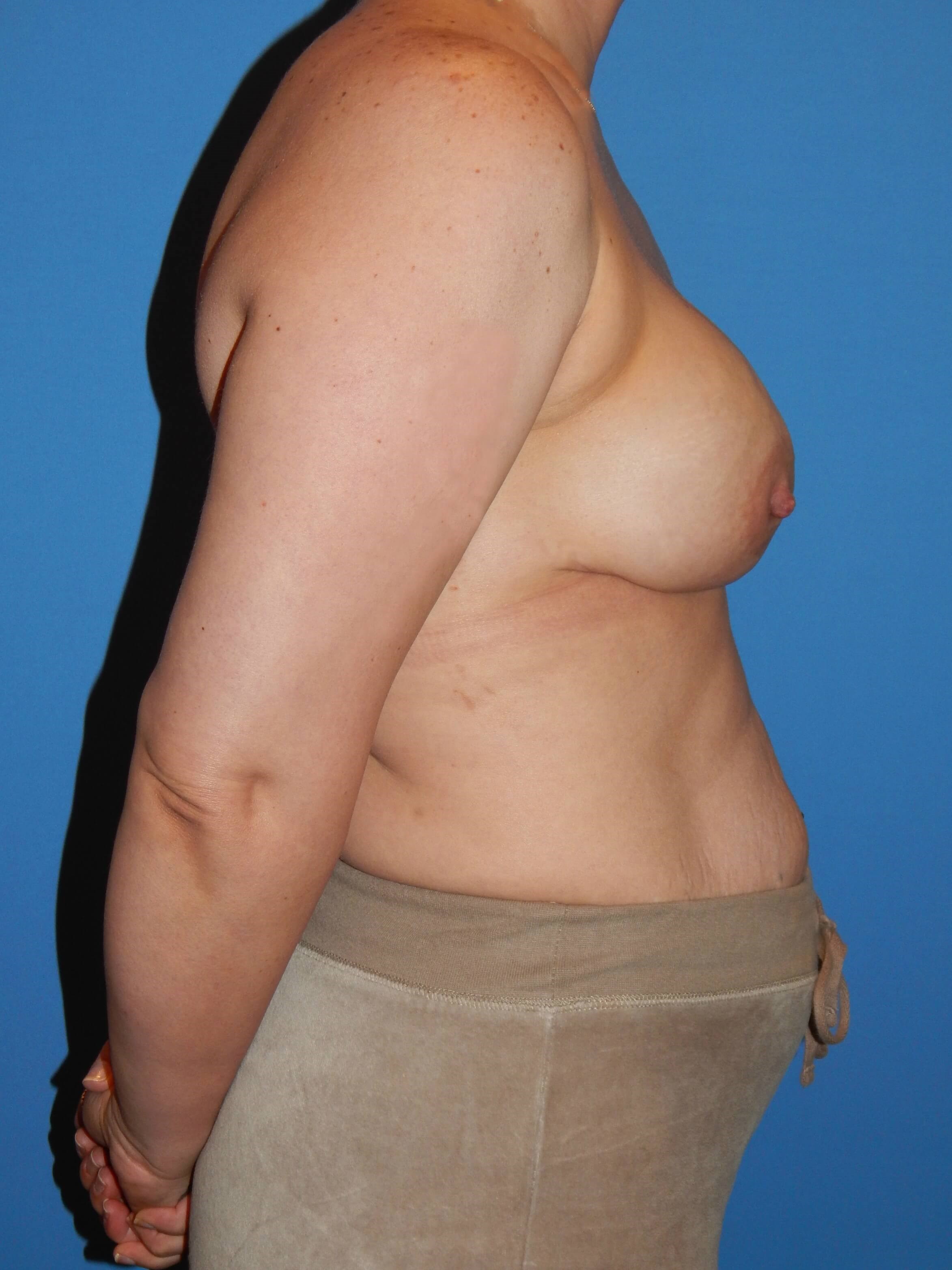 Side View After