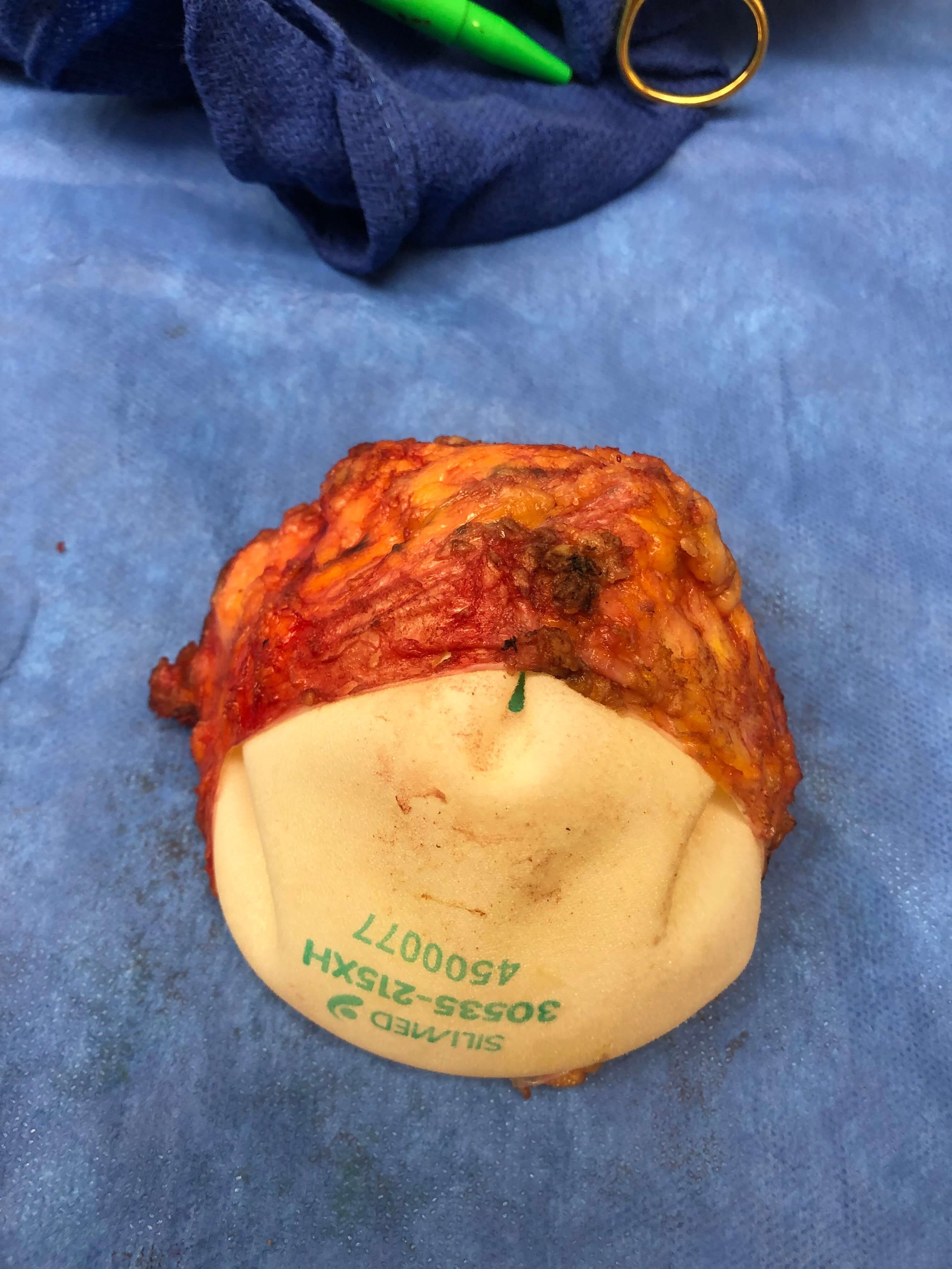 Enblock Breast Implant Removal After