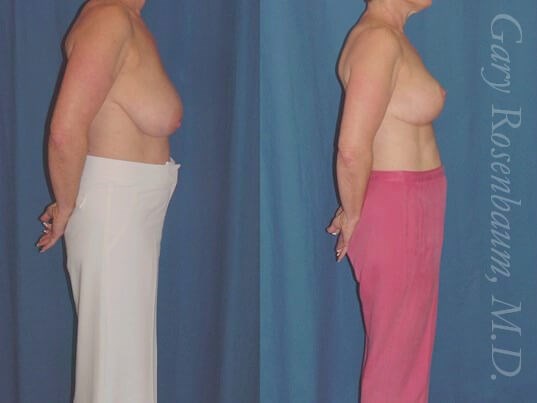 Breast Reduction 