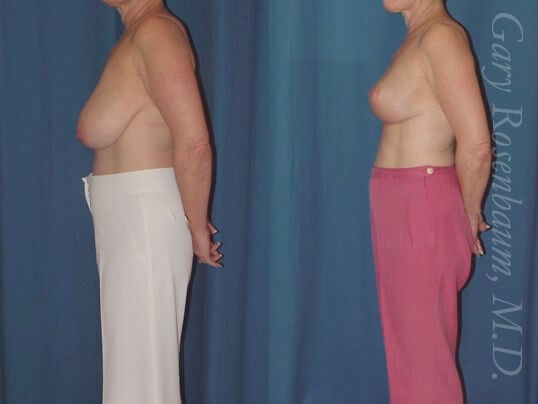 Breast Reduction 