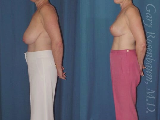 Breast Reduction 