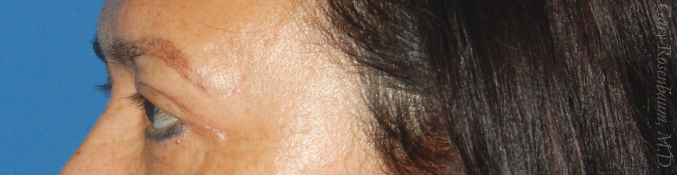 Side View After