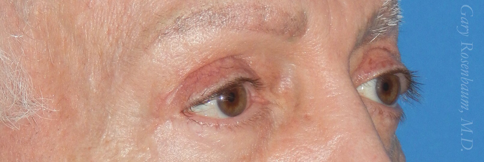 Partial Side View After