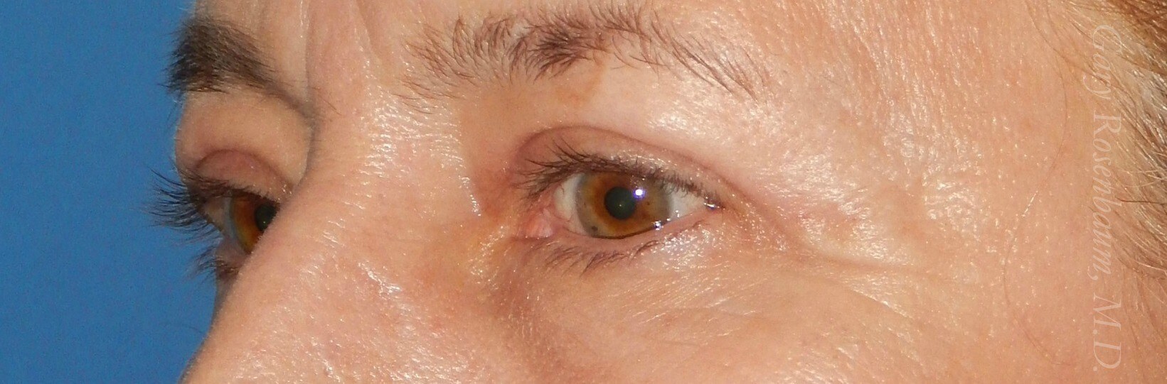 3/4 View After