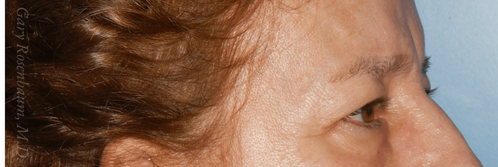 Upper Lid Bleph Lateral View Before