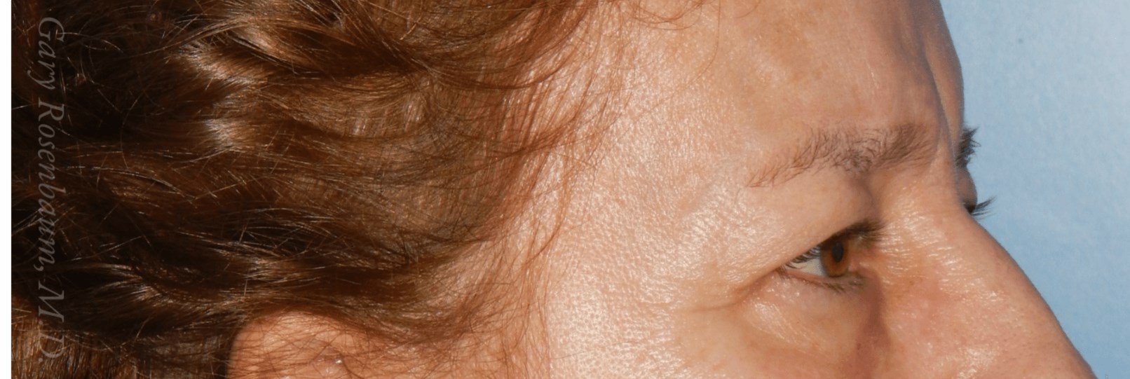 Upper Lid Bleph Lateral View Before
