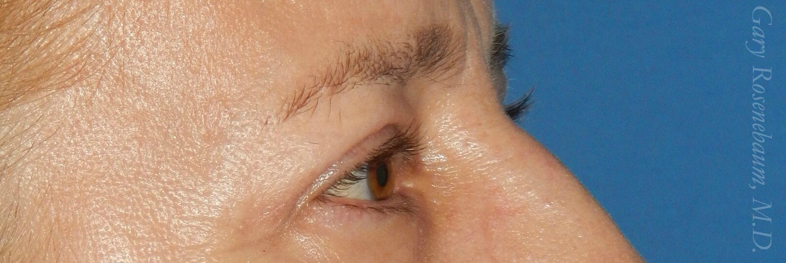 Upper Lid Bleph Lateral View After