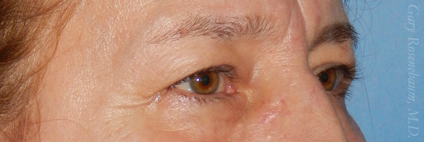 3/4 View Before