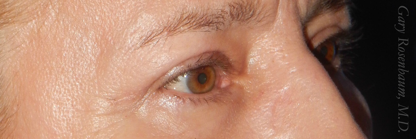 3/4 View After