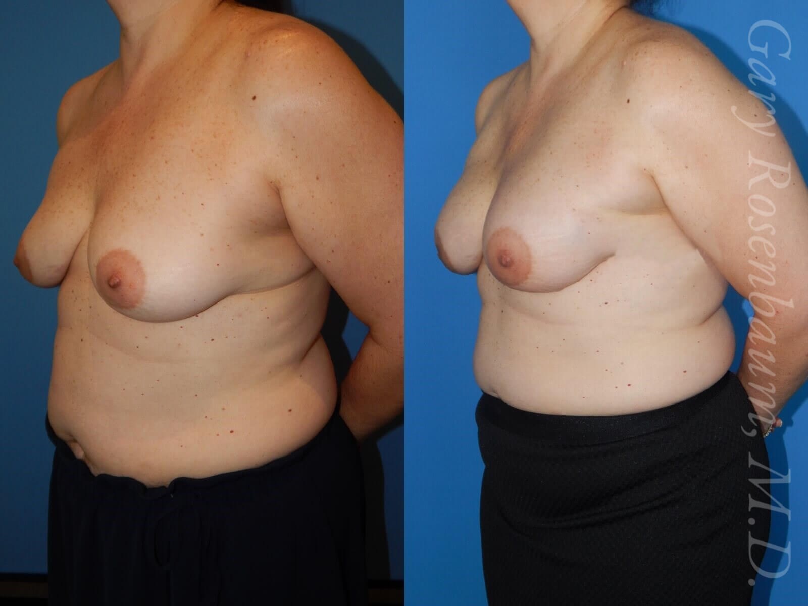 Nipple Sparring Mastectomy Before/After