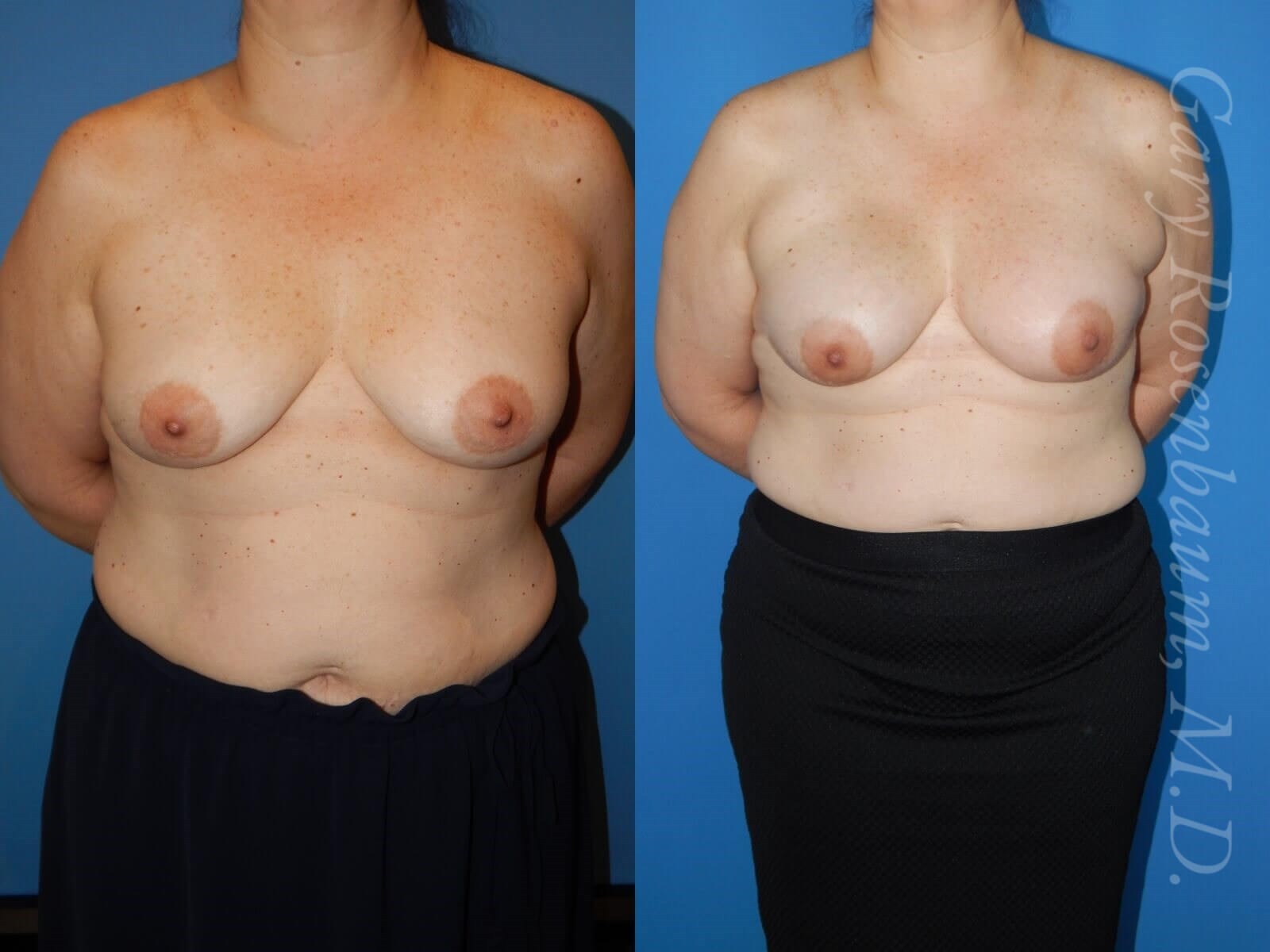 Nipple Sparring Mastectomy Before/After