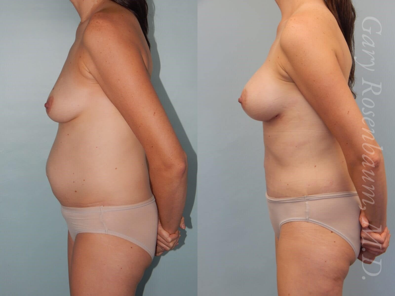 Breast lift, tummy tuck, lipo Side View