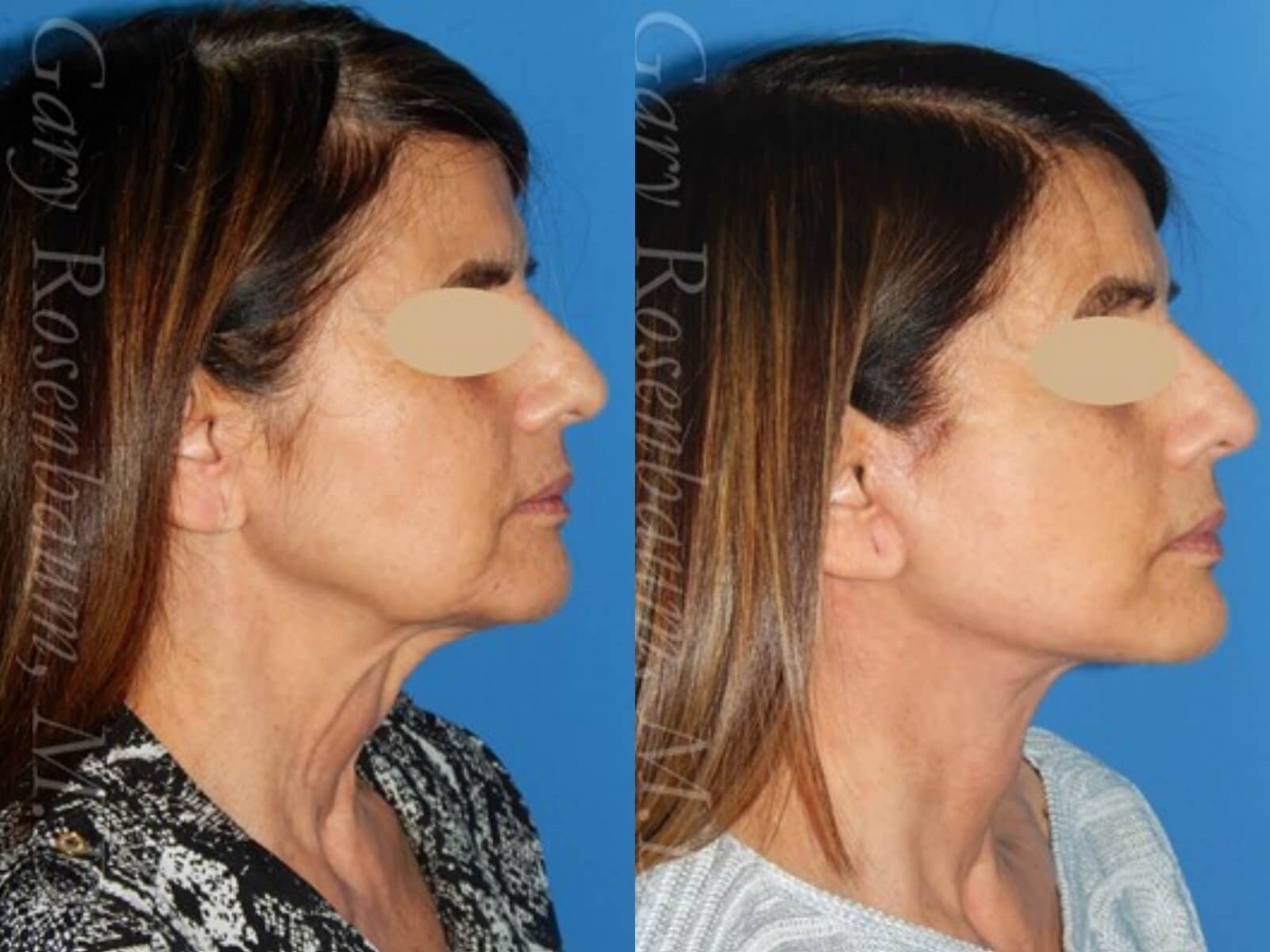 Facelift Before/After