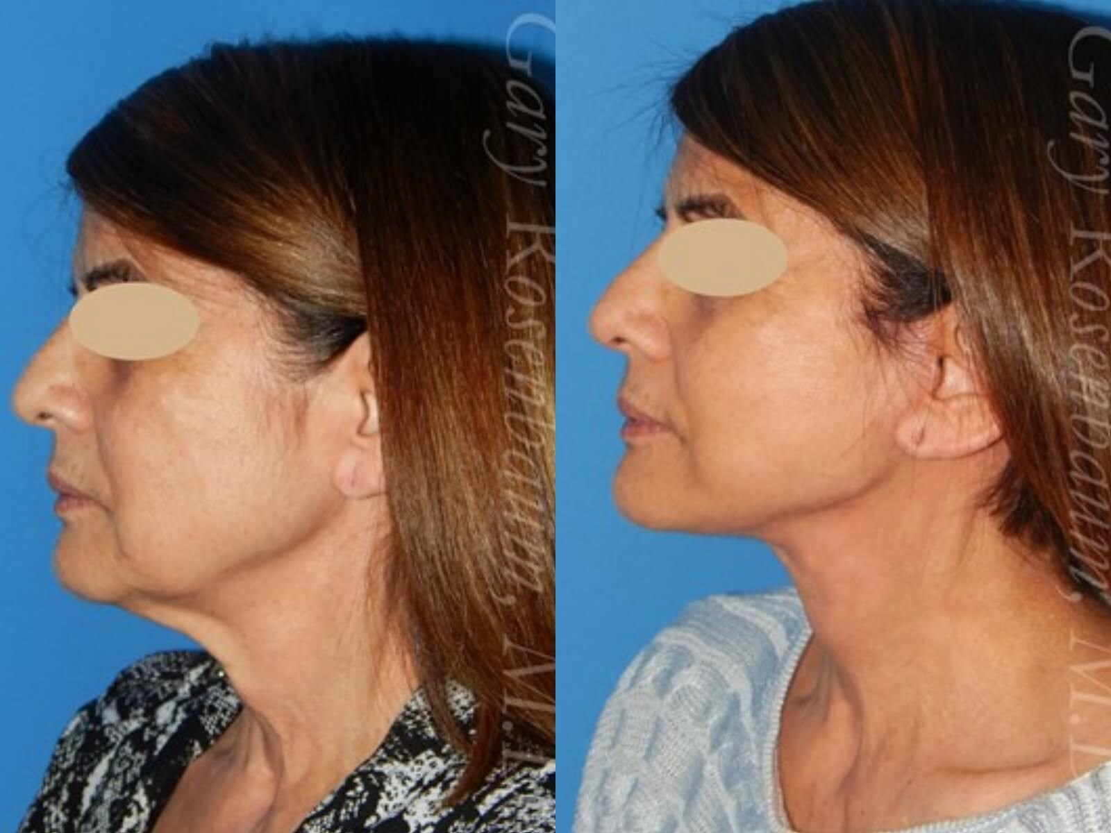 Facelift Before/After
