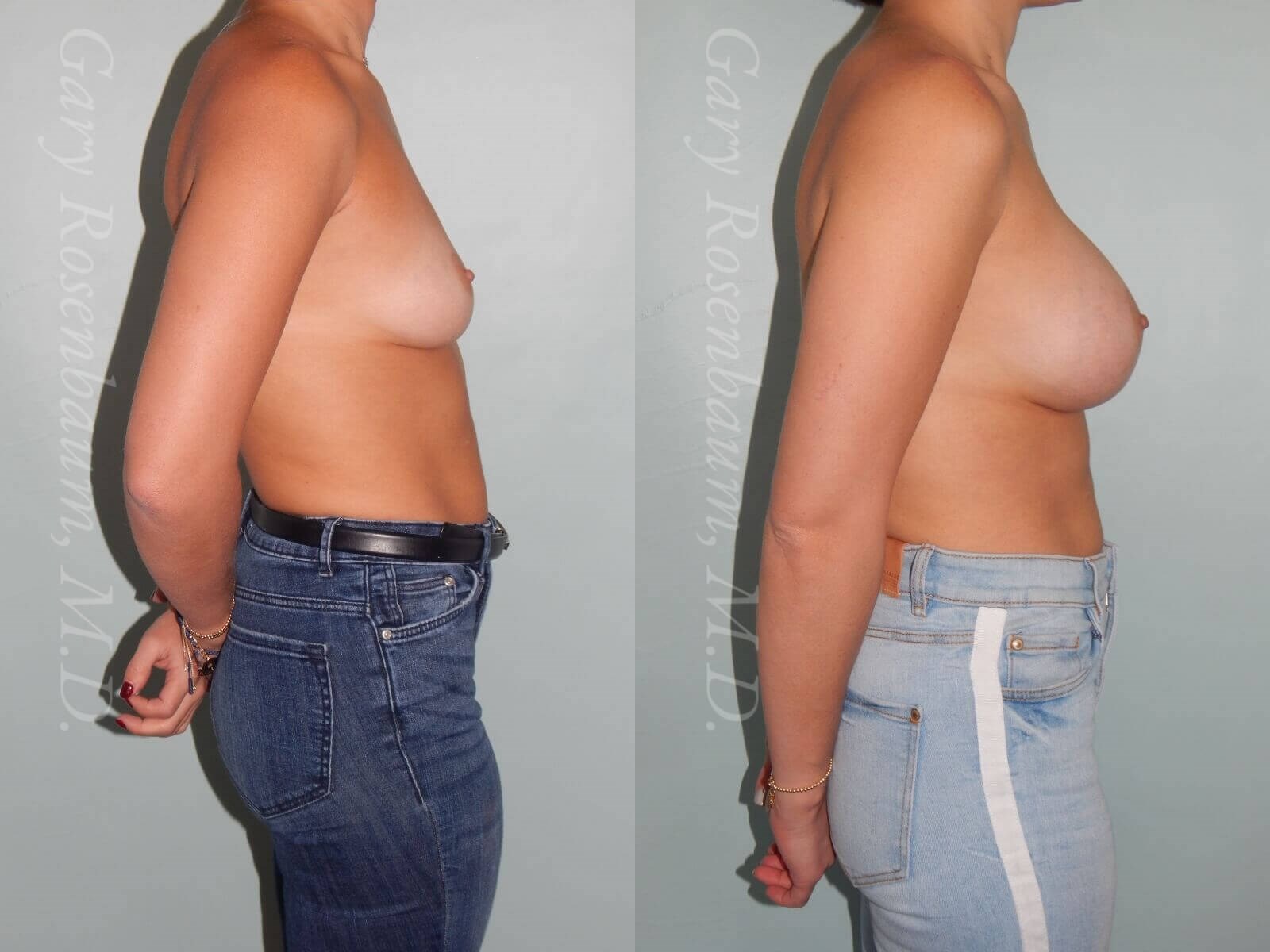 Side shows natural upper pole 