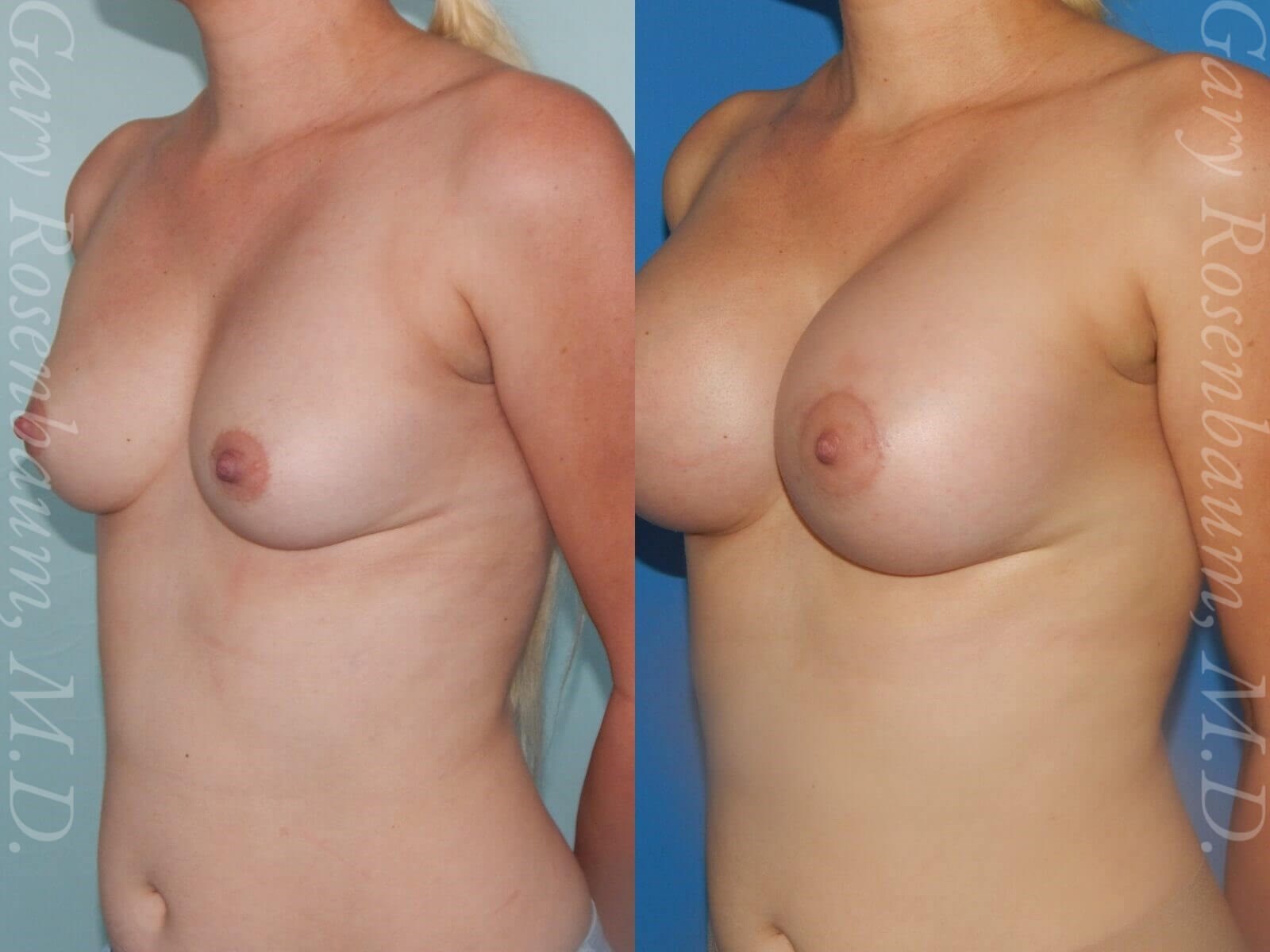 Breast Augmentation Lateral View