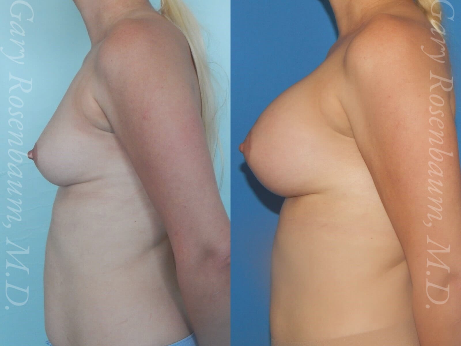Breast Augmentation Side View