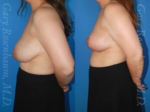 Breast Reduction with Lift Before/After
